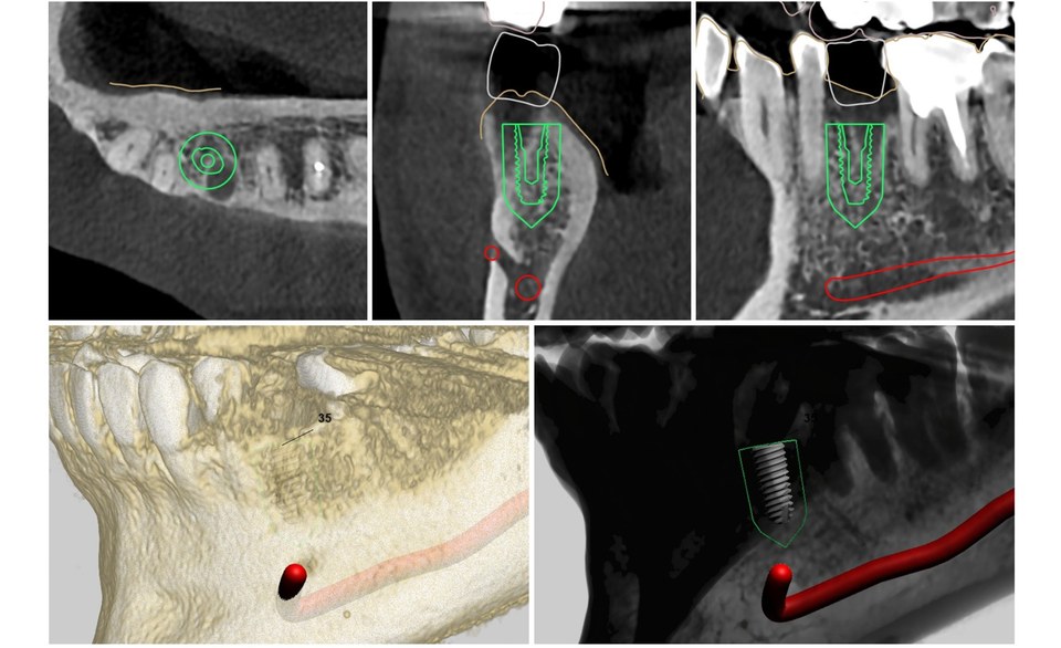 임플란트 CT 분석