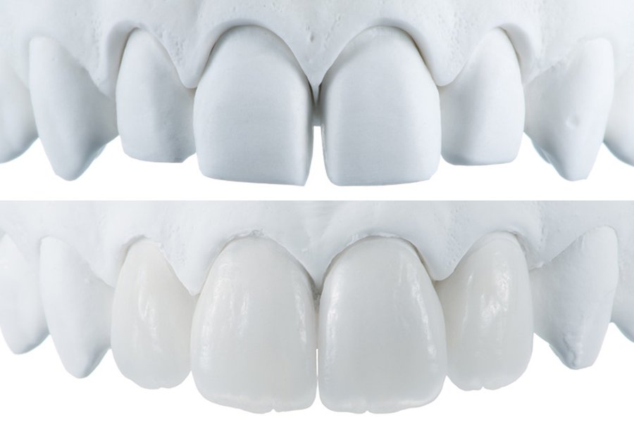 무삭제 라미네이트 제로디자인