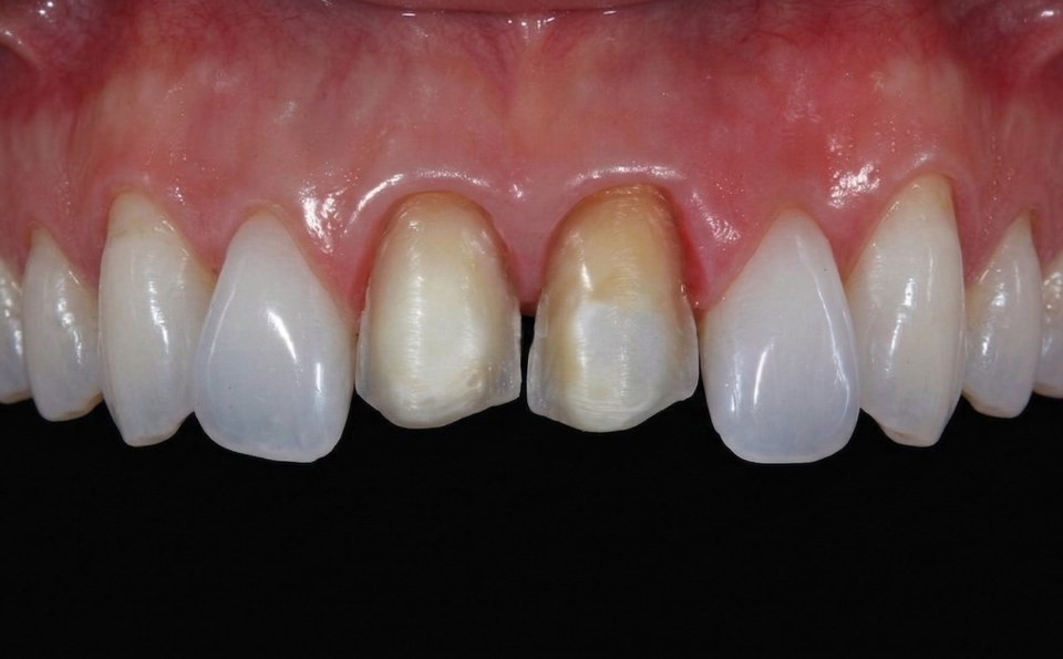 기존 라미네이트 삭제