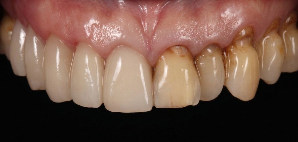 제로디자인 라미네이트 세트